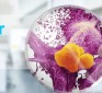 GcMAF: Another Suppressed Cancer Treatment? And here is how it is even more powerful…