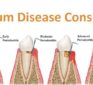 The Gum Disease Conspiracy