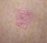 How I used 5,000 ppm Colloidal Silver to Kill Basal Cell Skin Cancer